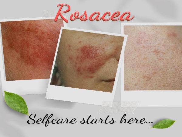 Organic Wash for Rosacea Prone Skin - For Women & Man-1
